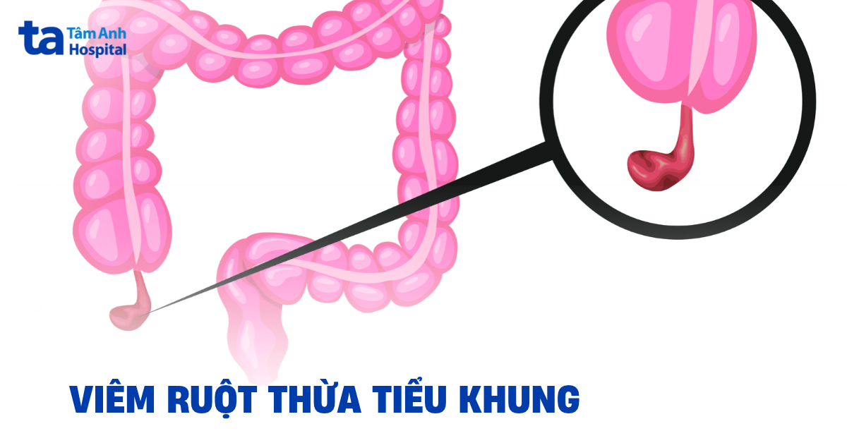 Viêm ruột thừa tiểu khung: Nhận biết triệu chứng