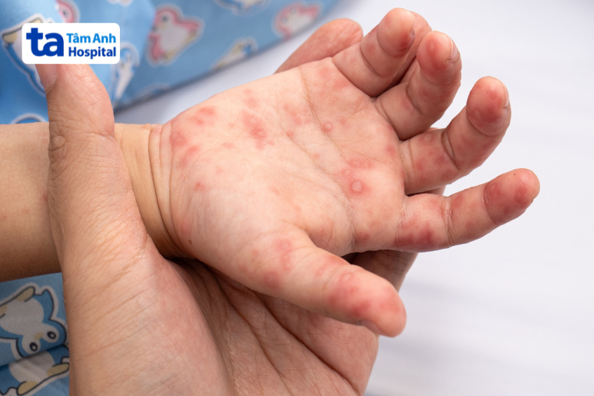 virus tay chân miệng có thể lây lan cho người lớn khi tiếp xúc trực tiếp