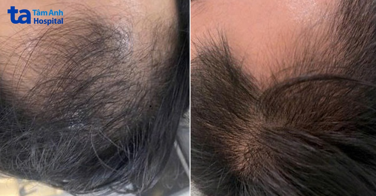 vùng da đầu đã cải thiện sau 3 lần điều trị