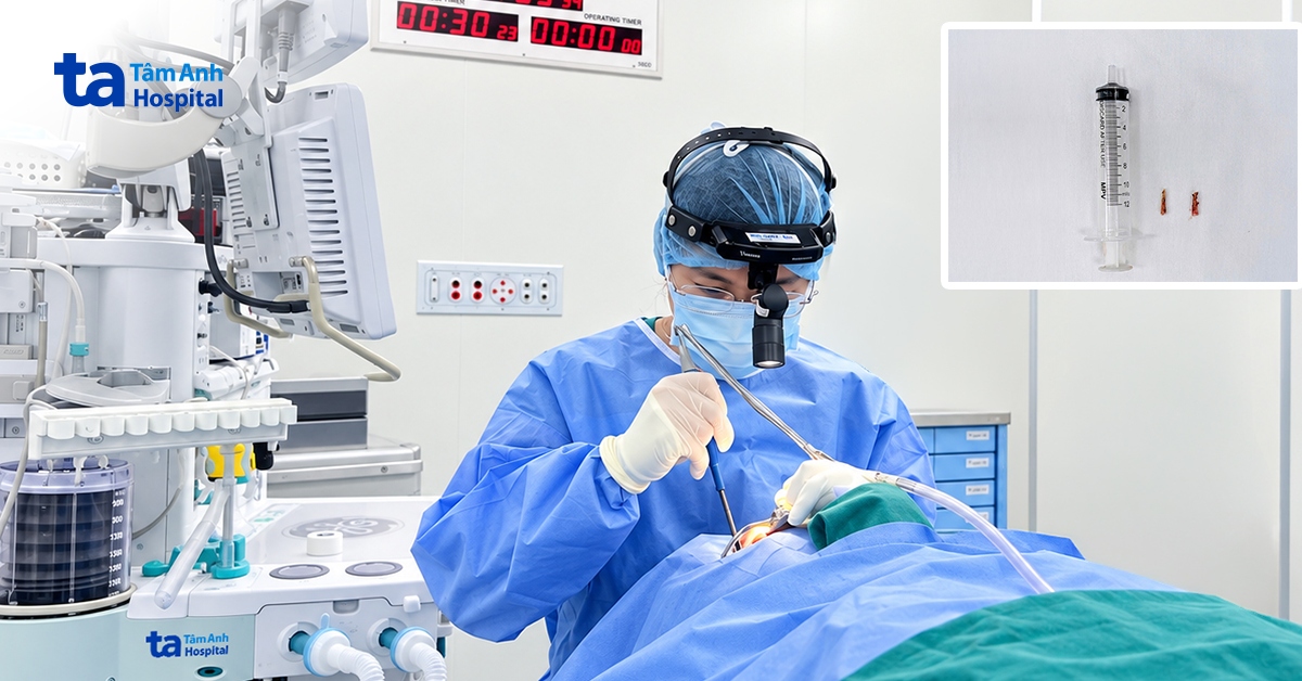 Dài mỏm trâm gây vướng họng kéo dài