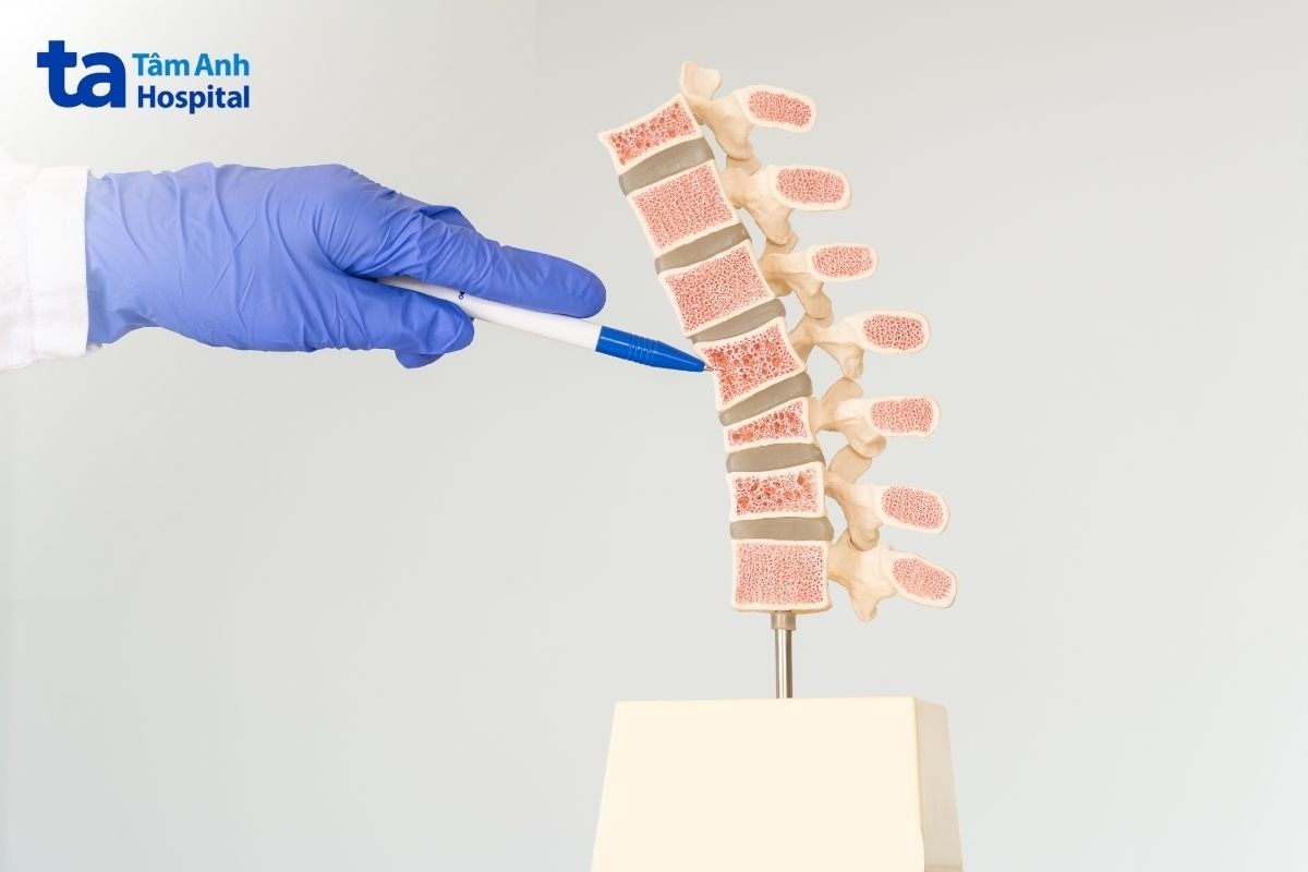 xẹp đốt sống có khỏi được không