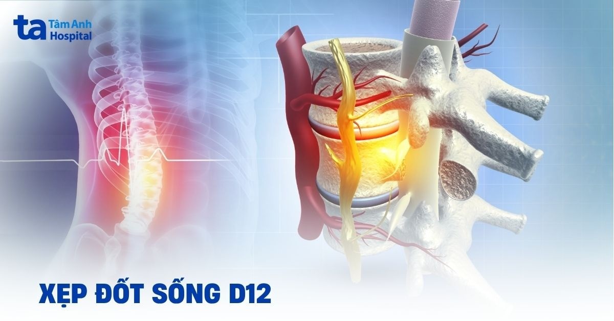 Xẹp đốt sống D12 có thể gây ra những vấn đề nào?
