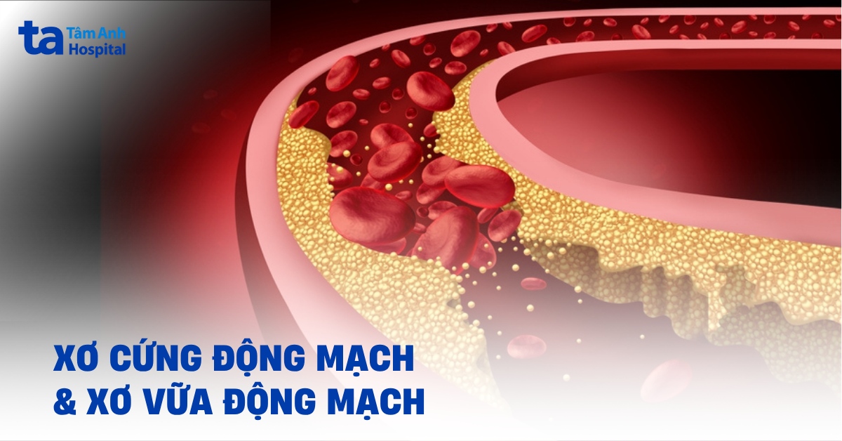 Điểm khác biệt giữa xơ cứng động mạch và xơ vữa động mạch