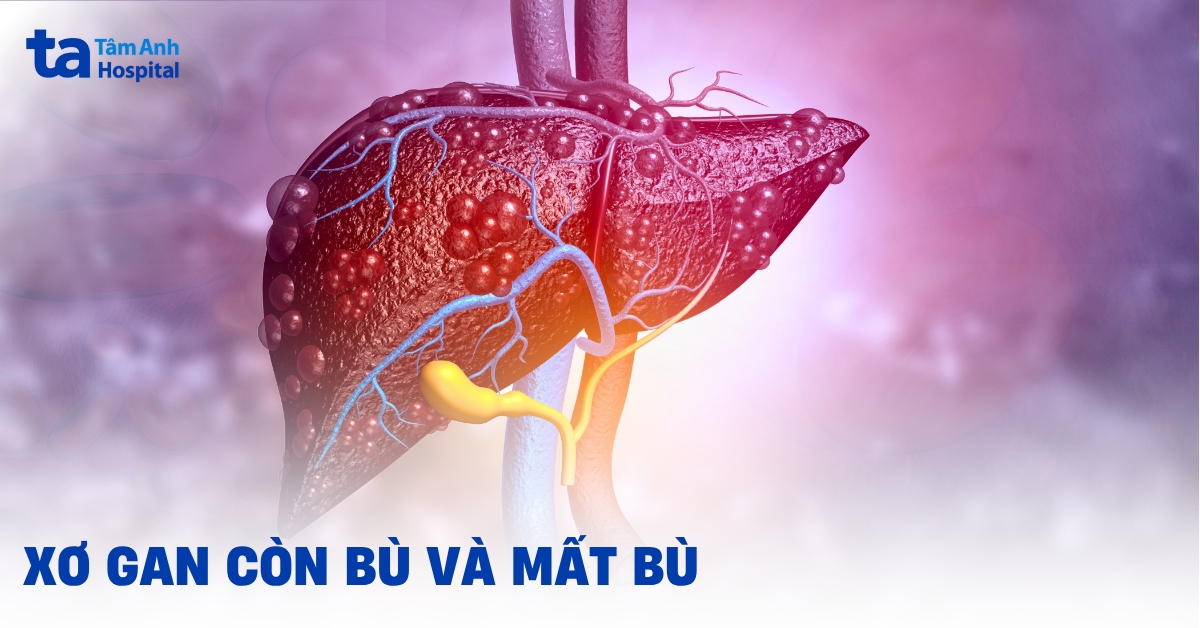 Phân biệt xơ gan còn bù và mất bù