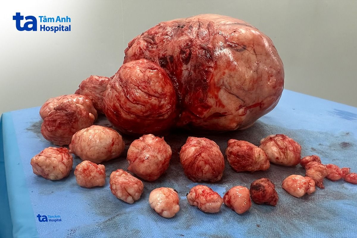 25 khối u xơ nhiều kích cỡ nặng gần 4,5 kg