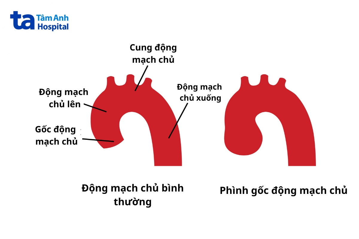 ai cần phẫu thuật thay thế gốc động mạch chủ
