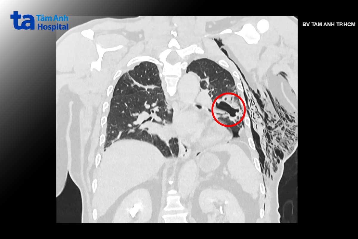Ảnh chụp CT lồng ngực cho thấy lỗ thủng khoảng 2 cm ở phổi trái người bệnh