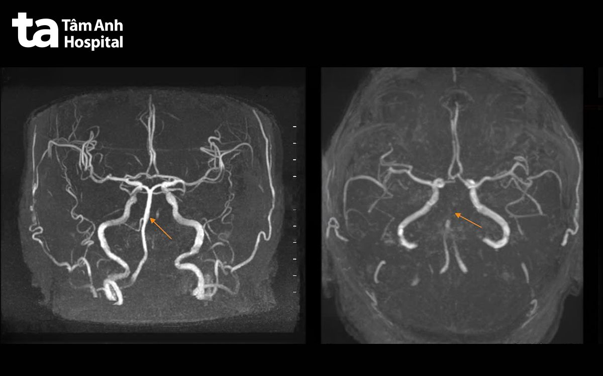ảnh mri mạch máu não của bà như lúc nhập viện