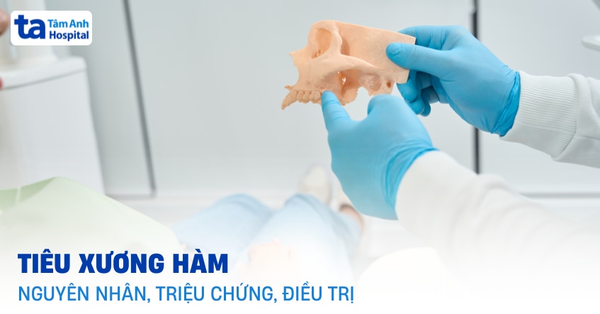 Tiêu xương hàm: Nguyên nhân, dấu hiệu và phương pháp điều trị