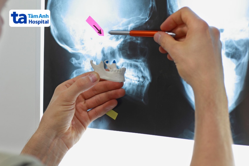 Bác sĩ cầm mô hình xương hàm và đọc phim X-quang vùng khớp thái dương hàm