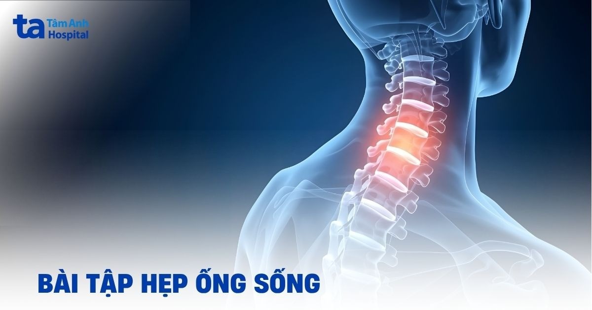Tổng hợp bài tập hẹp ống sống dễ thực hiện, giúp giảm đau