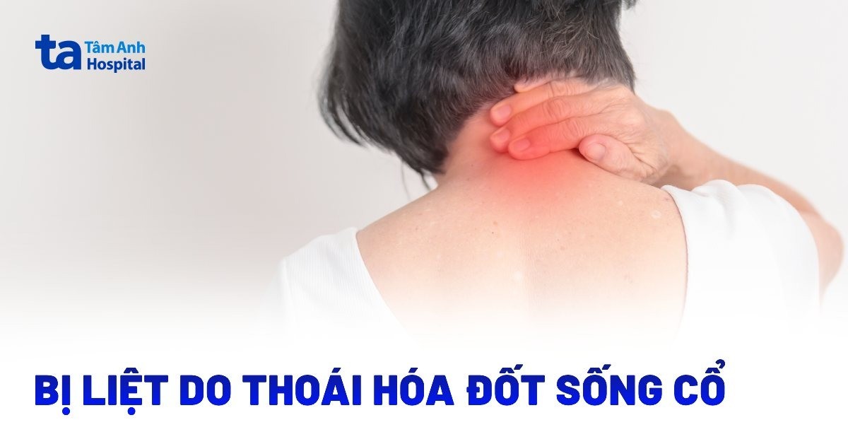 Bị liệt do thoái hóa đốt sống cổ là gì?