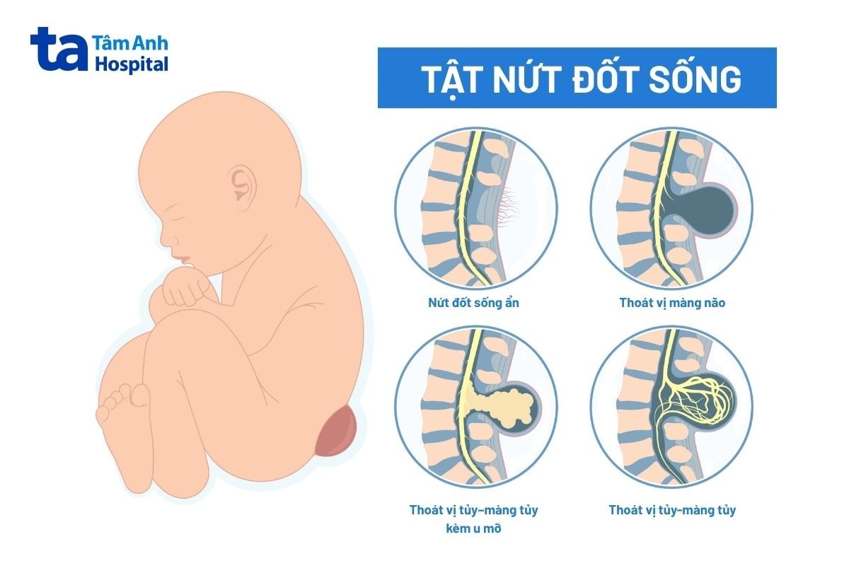 biểu hiện tật nứt đốt sống