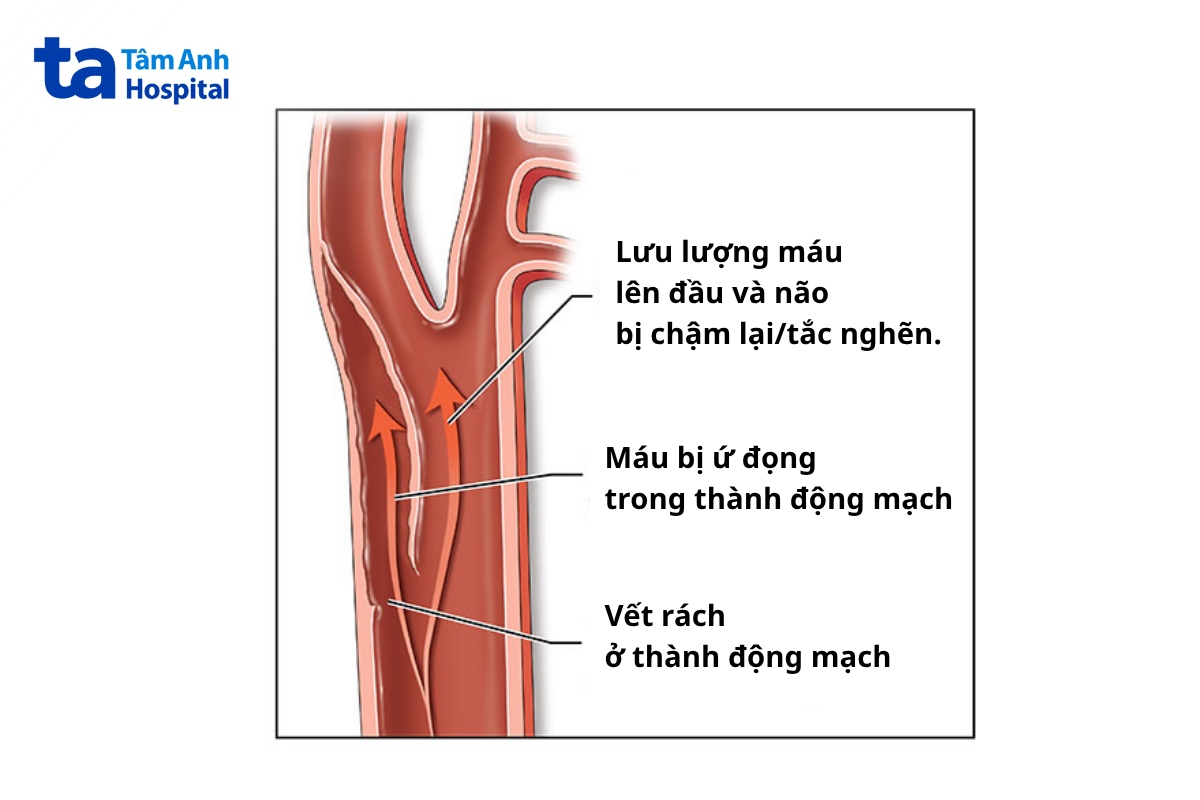 bóc tách động mạch cảnh là gì