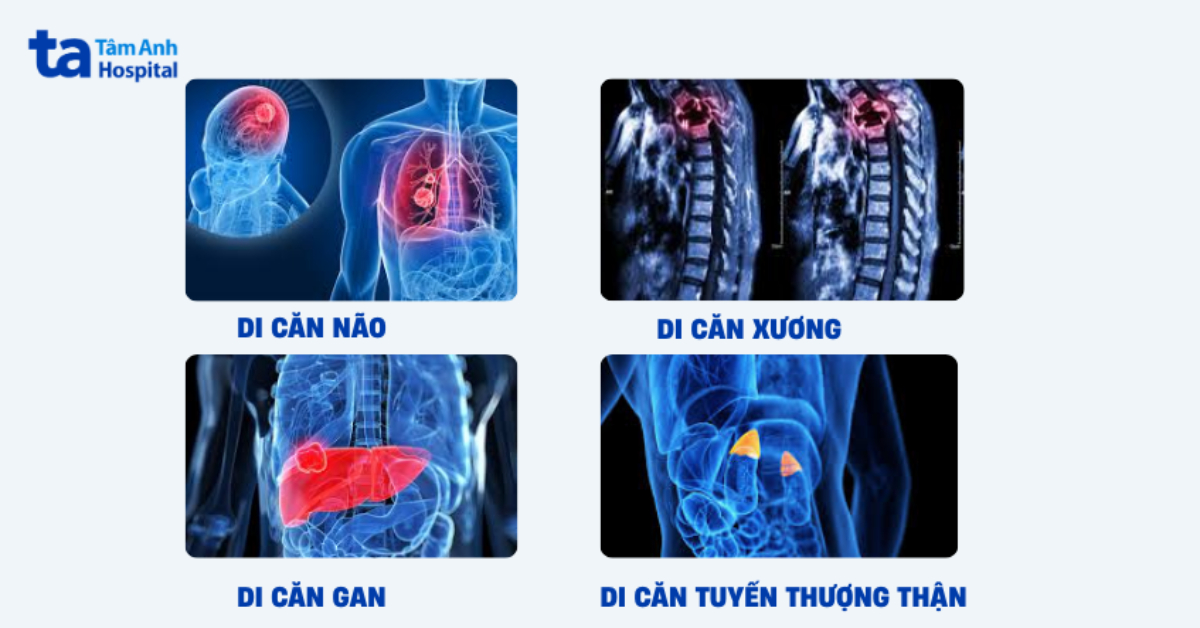 Các Cơ Quan Thường Chịu Ảnh Hưởng Khi Tế Bào Ung Thư Phổi Di Căn