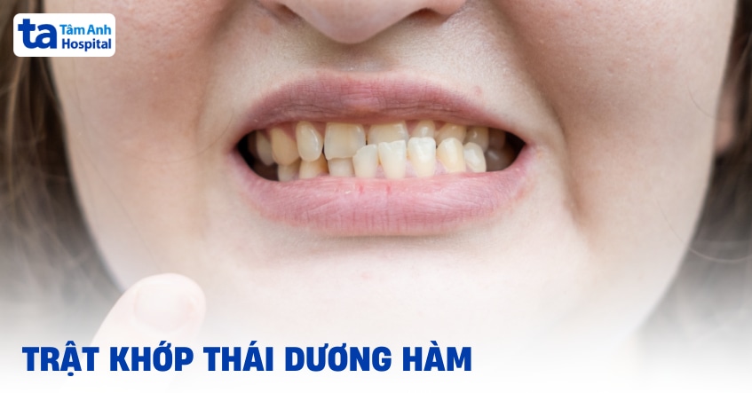 Trật khớp thái dương hàm: Triệu chứng, chẩn đoán và cách điều trị