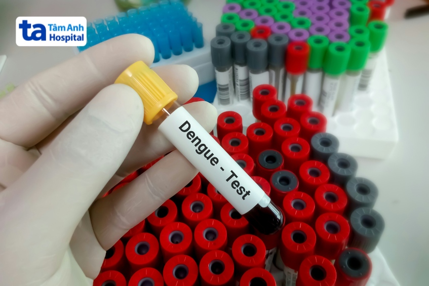 chẩn đoán bệnh sốt xuất huyết dengue