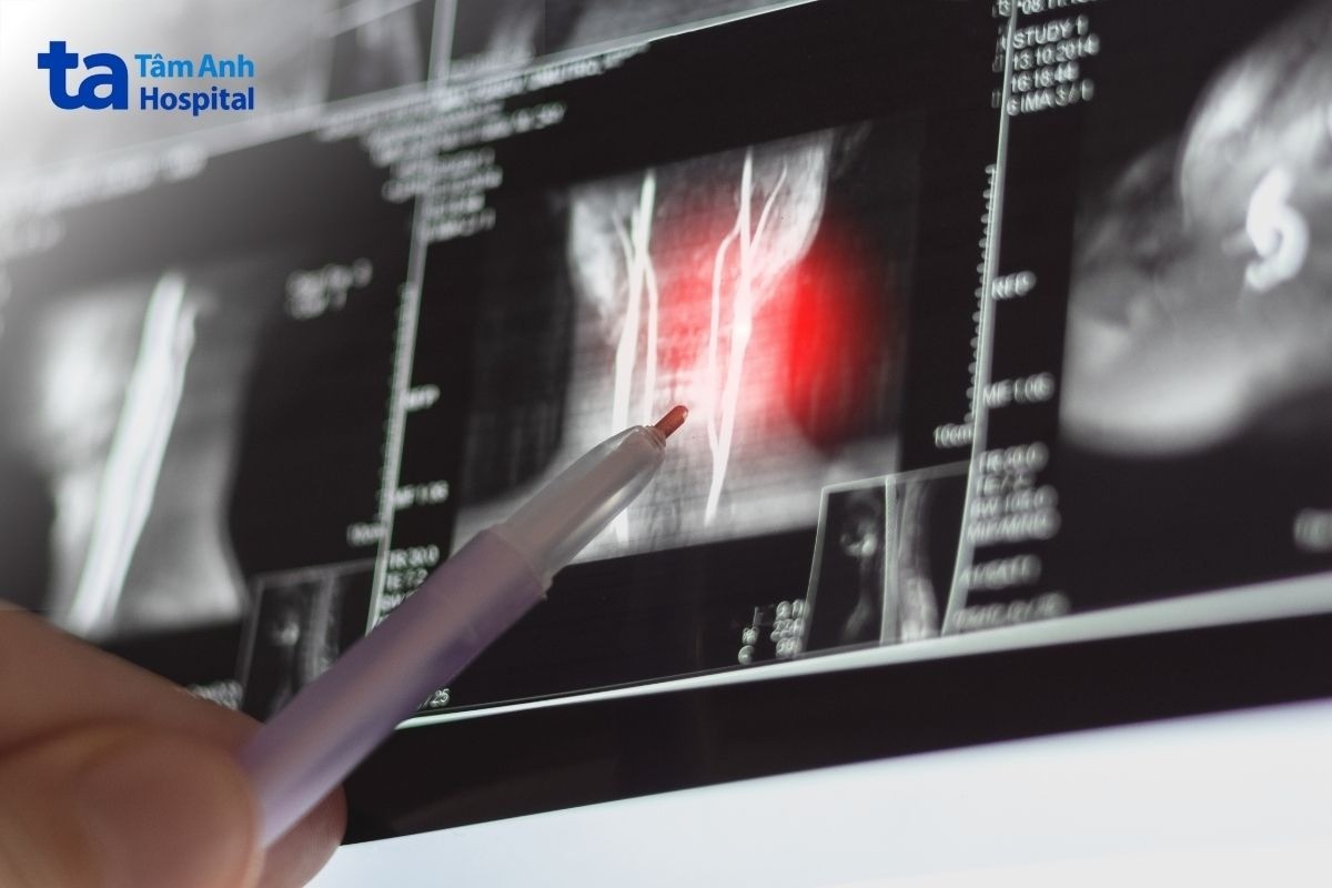 chẩn đoán chấn thương cột sống cổ​