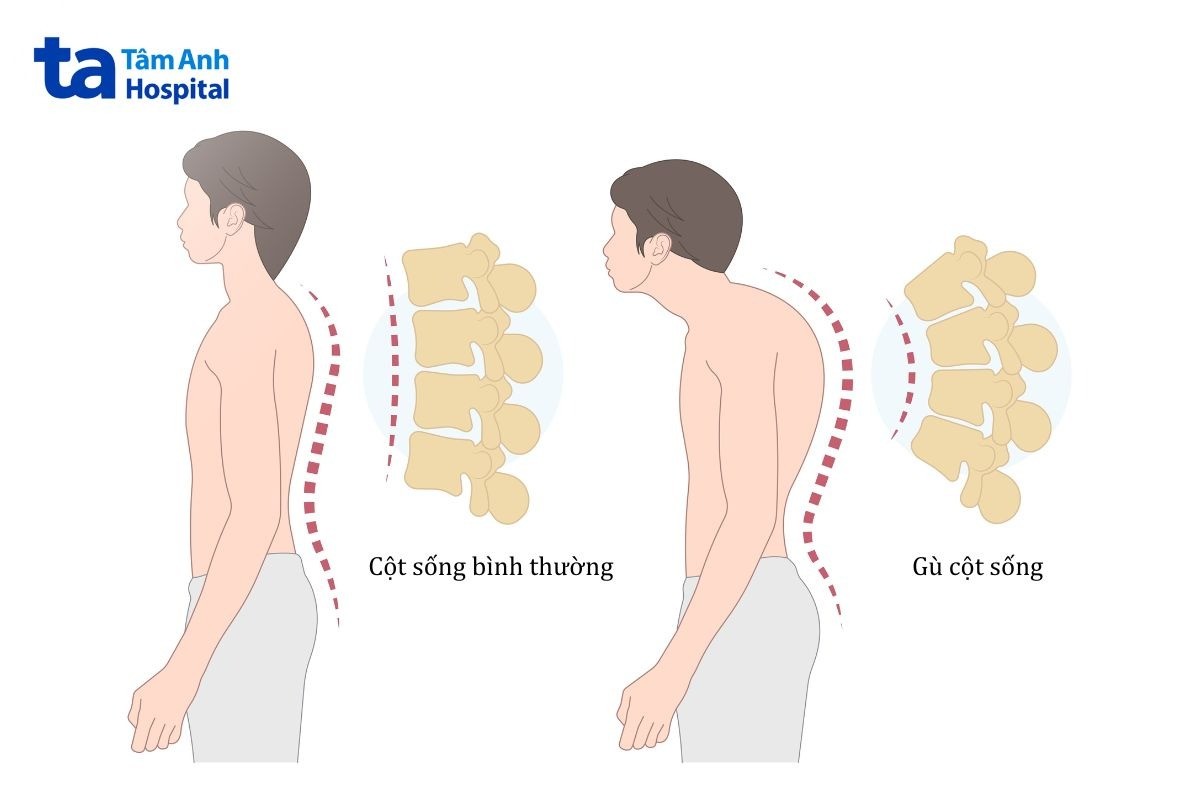 chấn thương vỡ lún cột sống