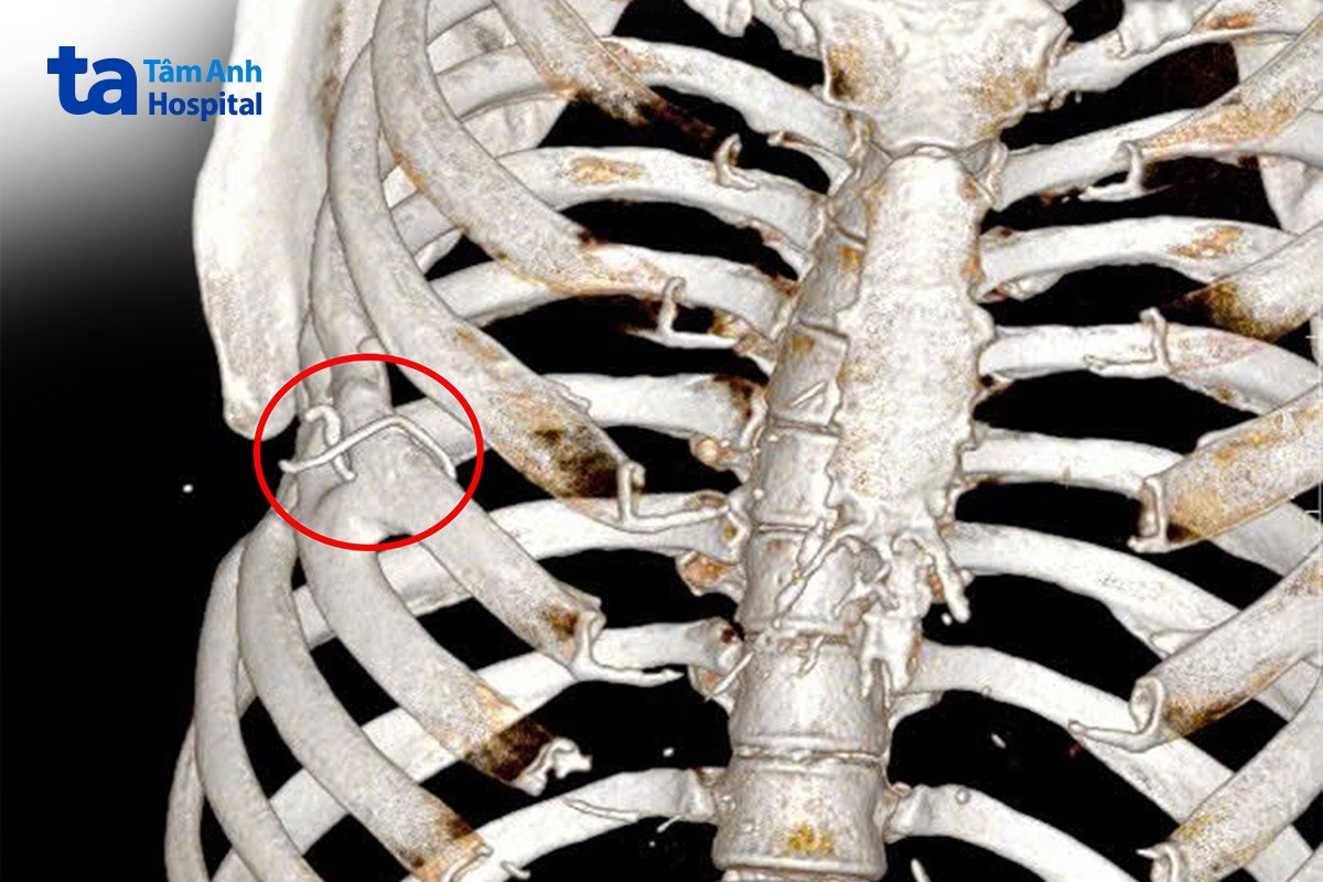 Chỉ kim loại mắc kẹt trong lồng ngực