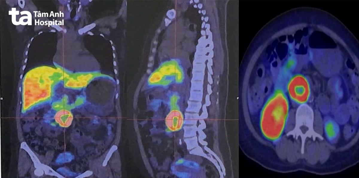 Chụp cắt lớp phát xạ positron kết hợp cắt lớp vi tính (PET/CT) với chất đánh dấu ⁶⁸Ga-DOTATATE đã xác nhận một khối u lớn nằm sau phúc mạc