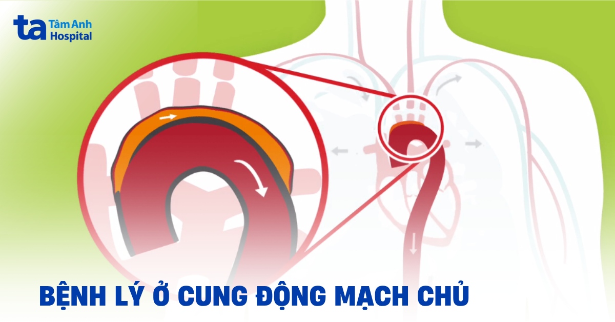 cung động mạch chủ