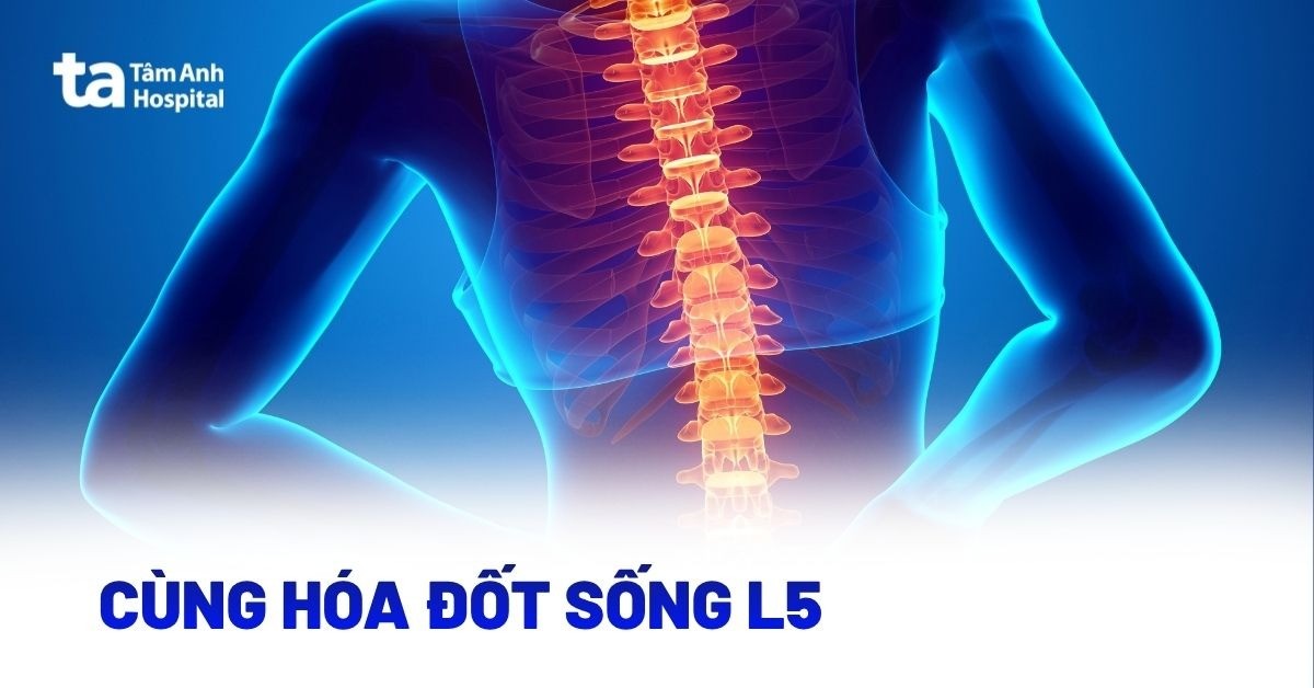 Cùng hóa đốt sống L5 và các giải pháp cần thực hiện