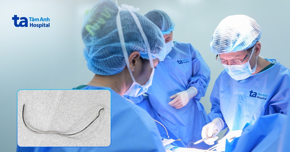Đoạn chỉ thép kẹt trong lồng ngực làm dính 2 xương sườn
