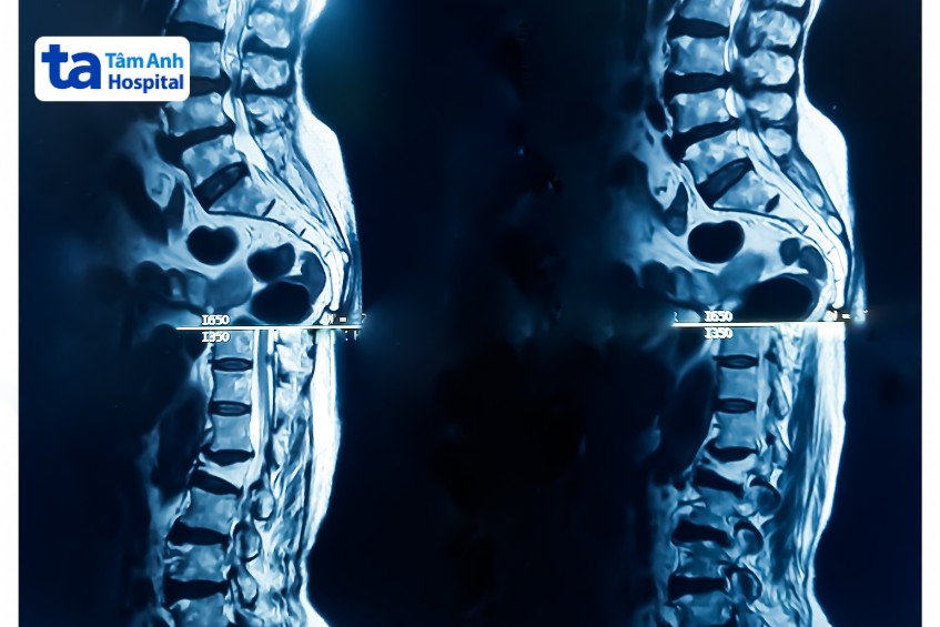 Giai Đoạn Biến Chứng Thoái Hóa Cột Sống​