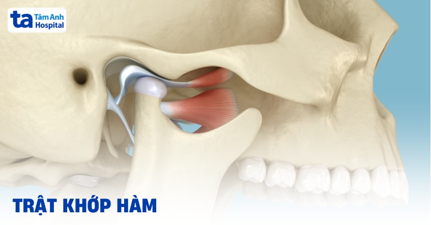 Trật khớp hàm phải làm sao? Khi nào cần đi khám ngay?