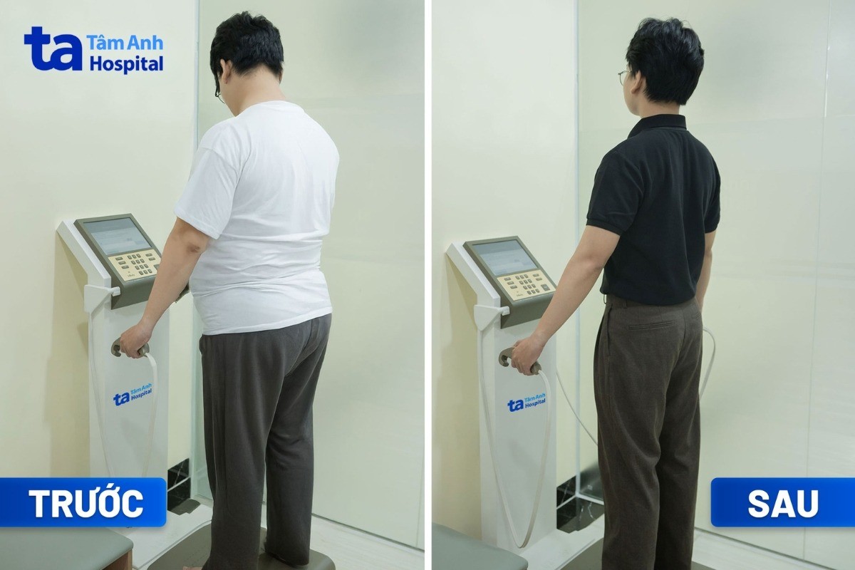 giảm cân thành công nhờ kết hợp sử dụng thuốc glp-1