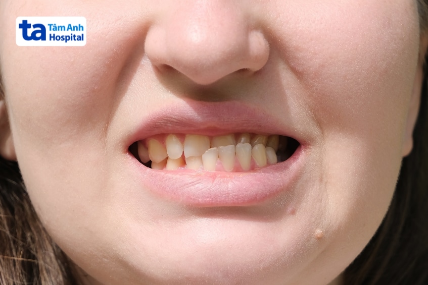 Cận cảnh khuôn miệng với hai hàm răng lệch khớp cắn khi cắn lại