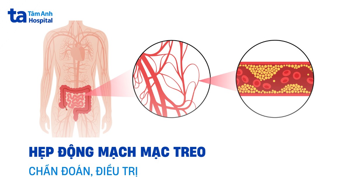 Hẹp động mạch mạc treo được chẩn đoán và điều trị như thế nào?