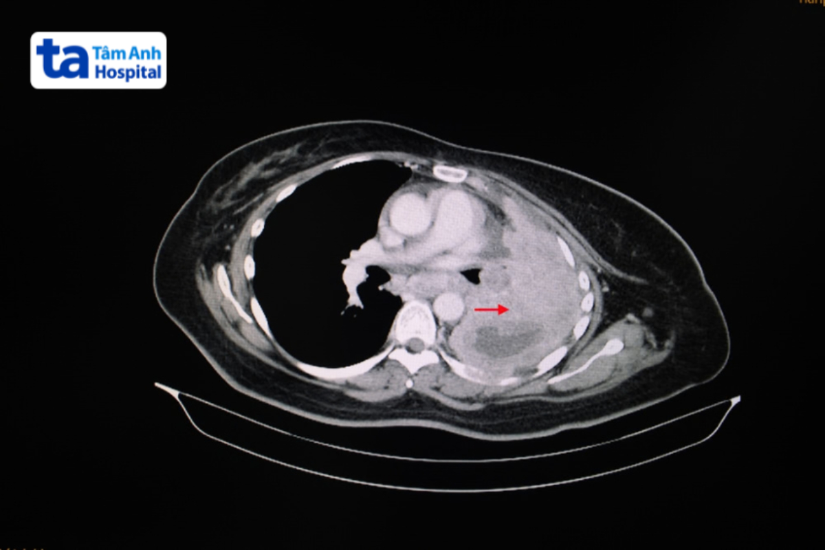 Hình Ảnh Ct Ngực