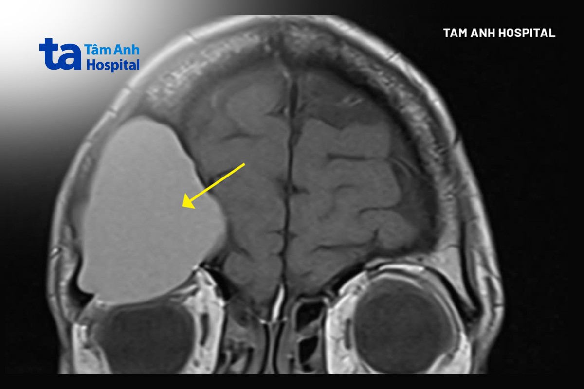 hình ảnh khối u lớn chèn ép nhãn cầu