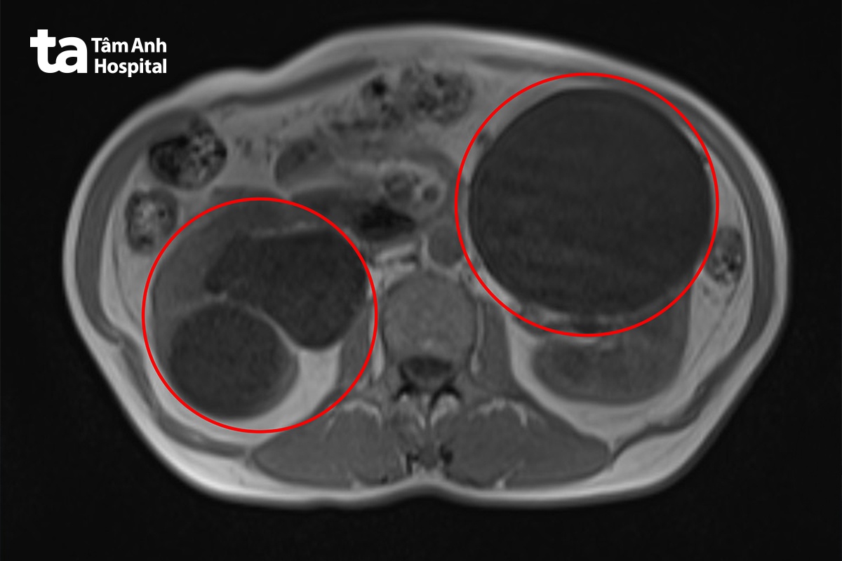hình ảnh mri ghi nhận nhiều nang thận lớn