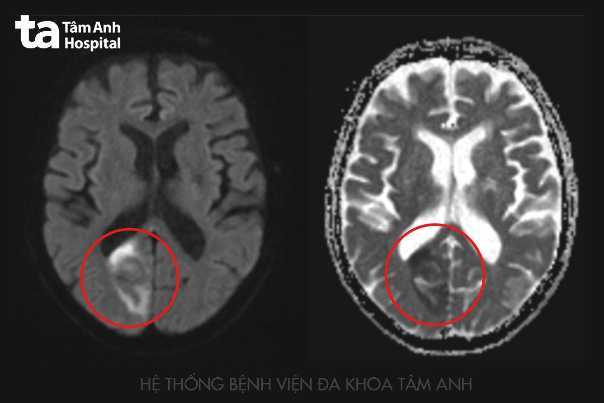 hình ảnh mri ghi nhận ông định có nhồi máu não
