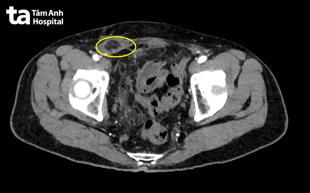 hình CT khối thoát vị bẹn