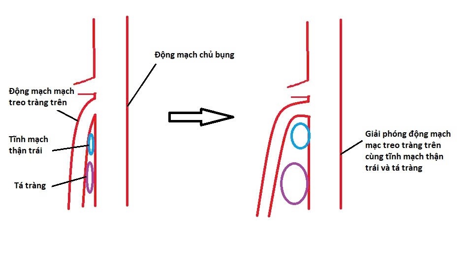 Hình mô tả trước và sau phẫu thuật nội soi giải phóng động mạch mạc treo tràng trên cùng tĩnh mạch thận và tá tràng