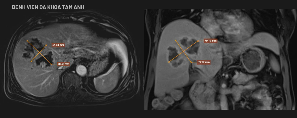 hình MRI ổ áp xe lớn