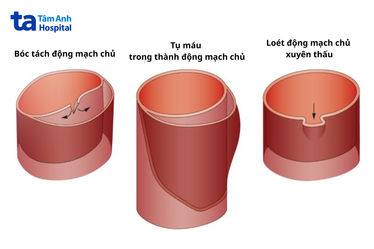 hội chứng cung động mạch chủ