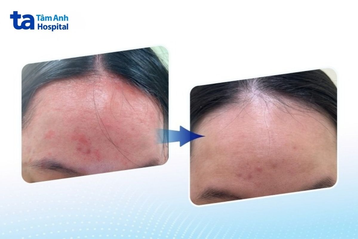 hưởng ứng ngày vảy nến thế giới