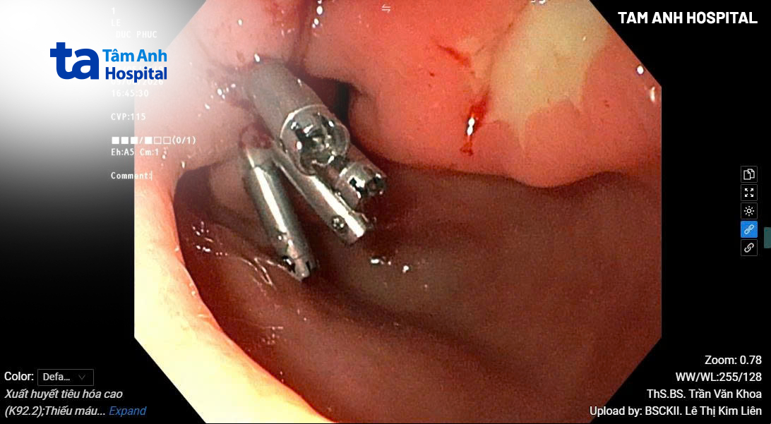 kẹp clip cầm máu