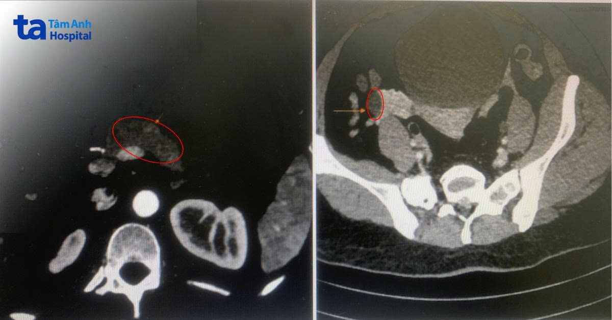 kết quả chụp ct scan khối u tụy nội tiết