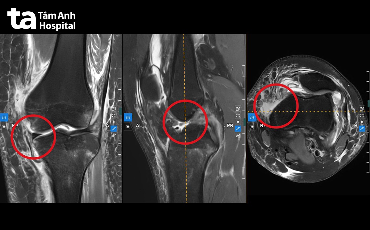 Kết quả chụp MRI cho thấy Phương bị đứt 3 dây chằng cùng lúc.