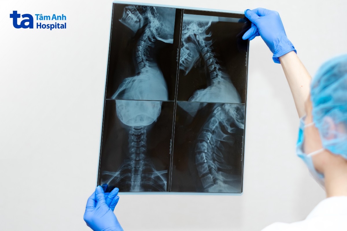 kết quả x quang cột sống cổ chếch 3 4