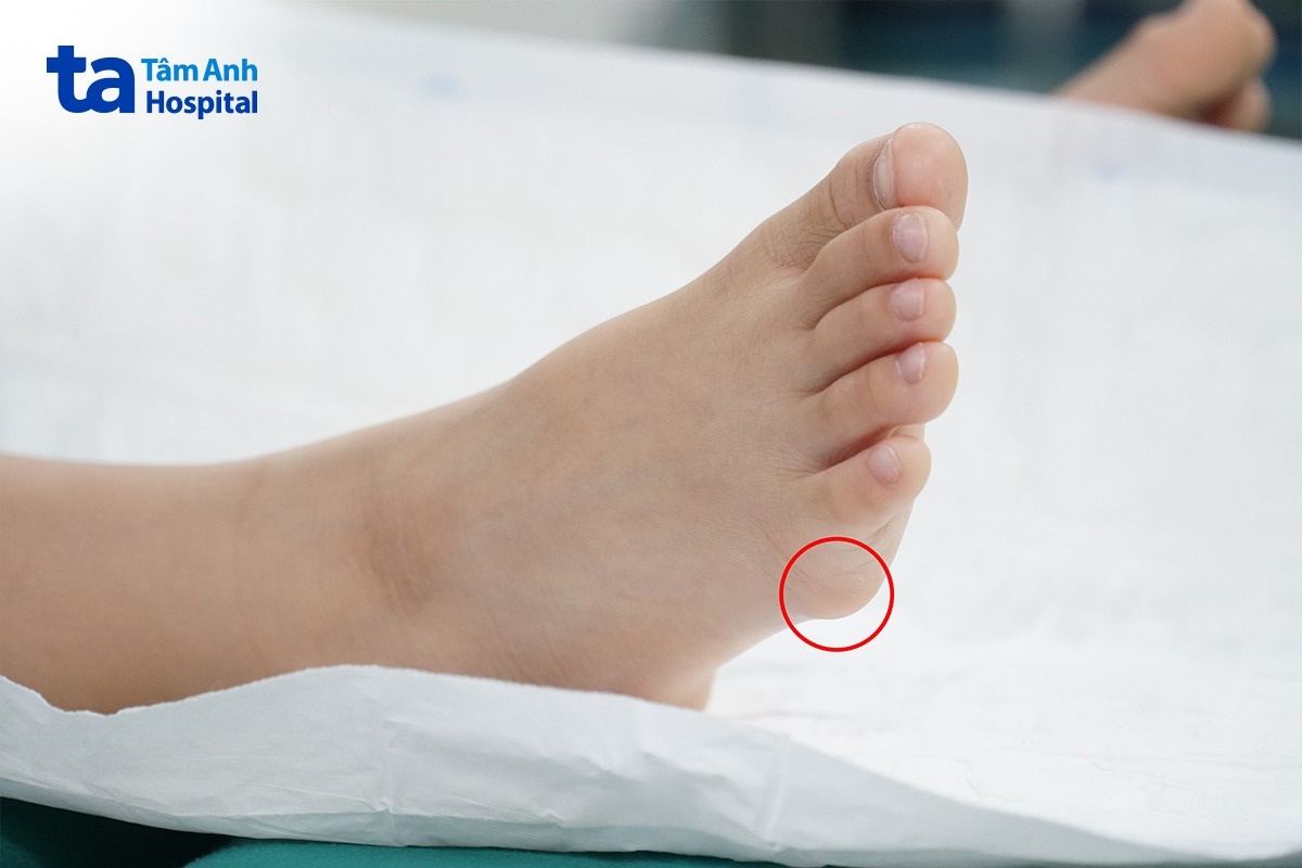 khối kén nổi cộm ở cạnh ngoài bàn chân phải