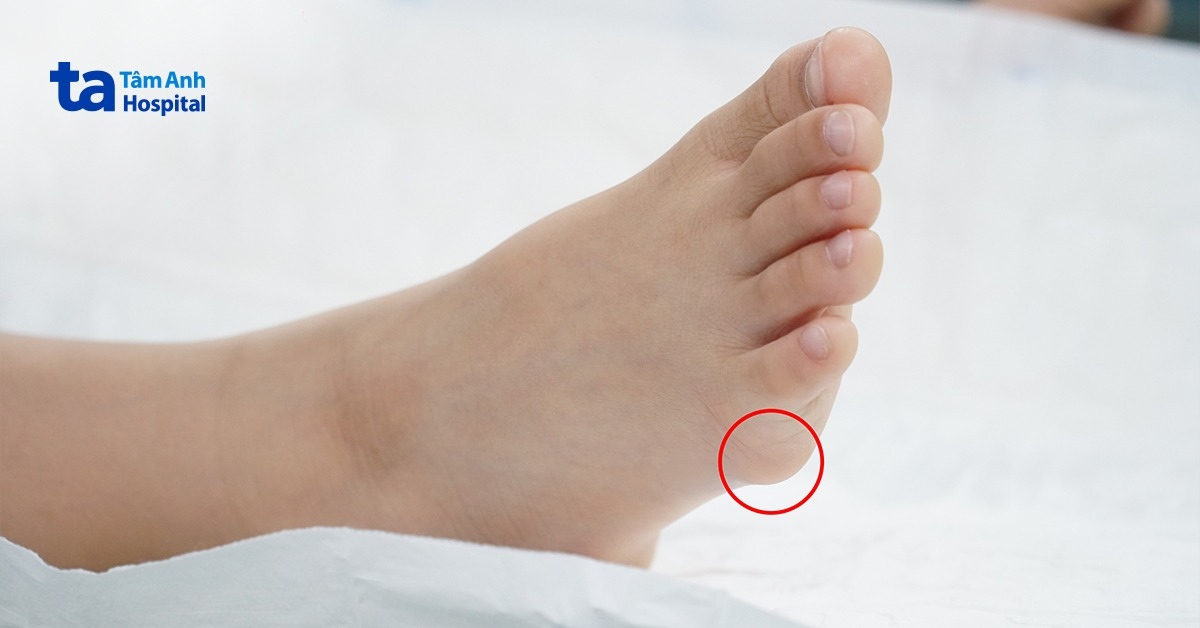 Khối kén vôi hóa hiếm gặp dưới bàn chân bé 7 tuổi