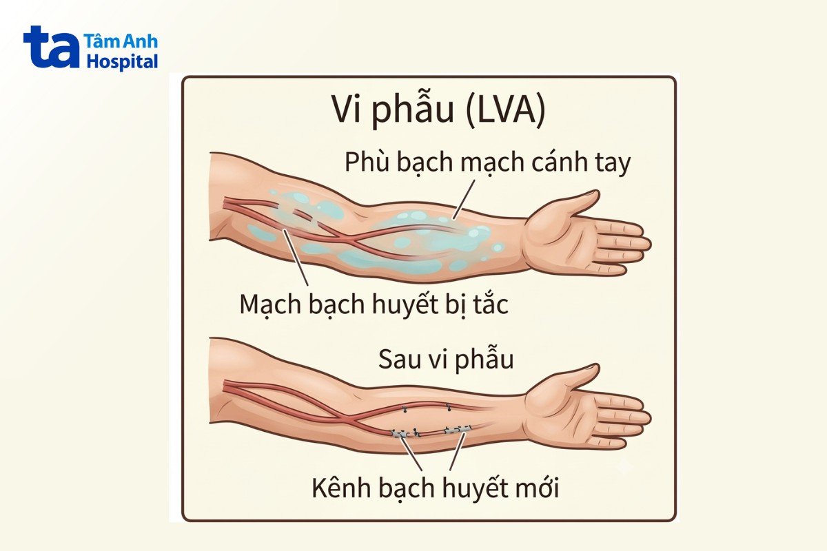 Kỹ Thuật Vi Phẫu Điều Trị Phù Bạch Mạch