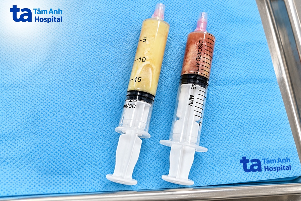 lượng dịch lấy ra từ màng phổi của người bệnh có màu vàng đục